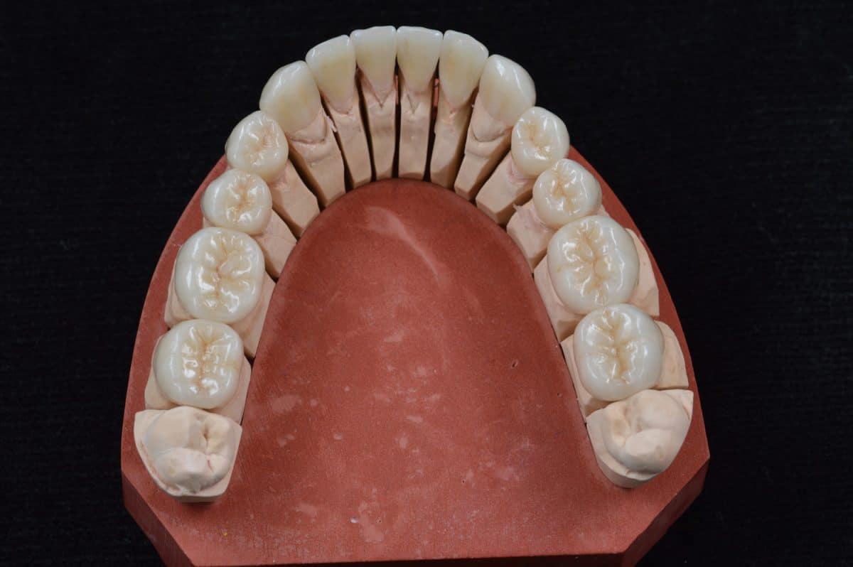 sandmair-zahntechnik-keramik-emax-DSC-0470-1200x798